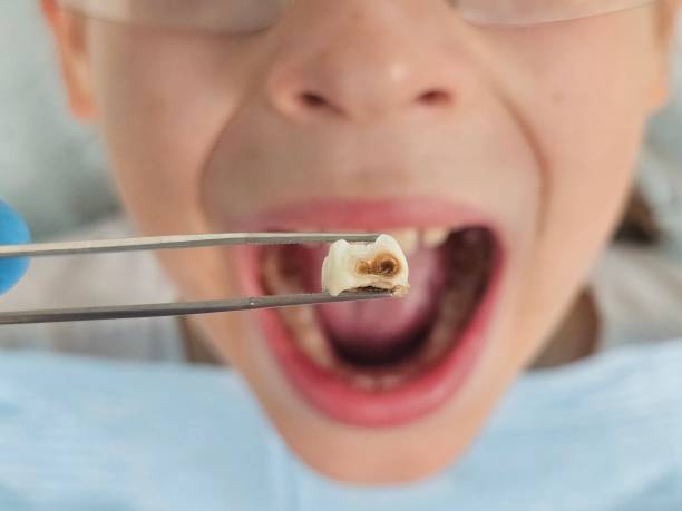 Best Dental Abscess Treatment in Lakewood Clu, MI
